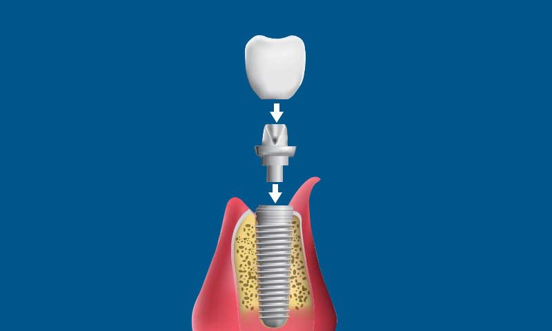 Diagram showing a dental implant: a tooth crown above an abutment and screw, all positioned above gum tissue and jawbone, with arrows indicating assembly. Blue background.